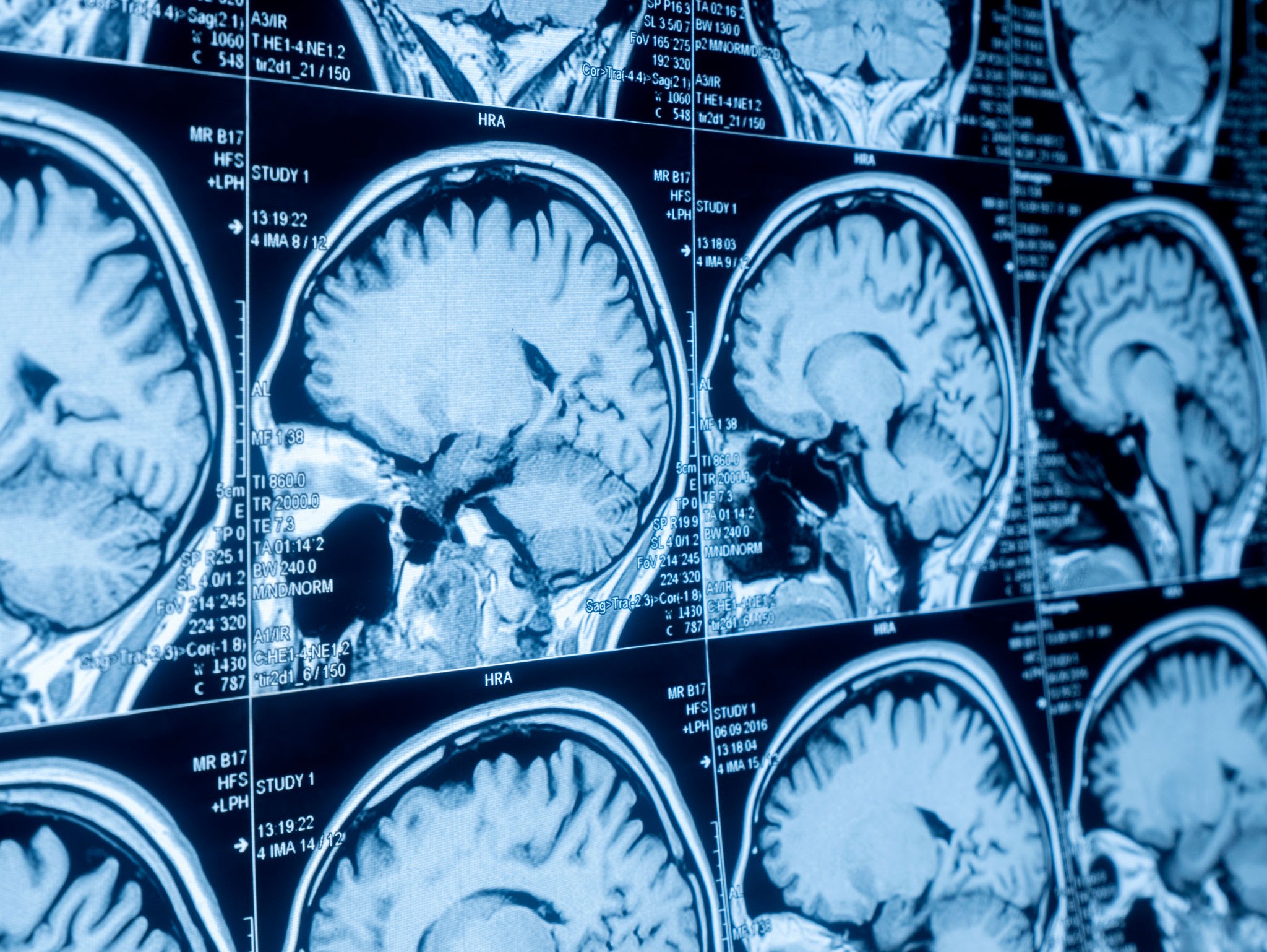 دليل شامل حول أسعار أشعة الرنين المغناطيسي (MRI) لعام 2026